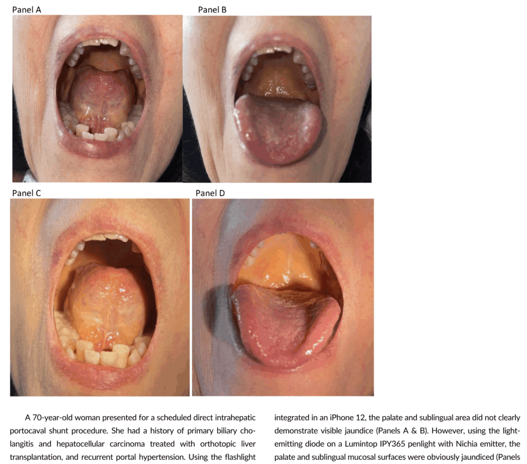 Nichia emitter getting some love in Journal of Hospital Medicine.