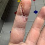 Update: 3 weeks after getting got