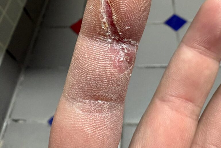 Update: 3 weeks after getting got