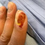 FingertipFriday - fortnightly follow-up