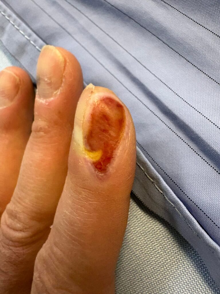 FingertipFriday - fortnightly follow-up